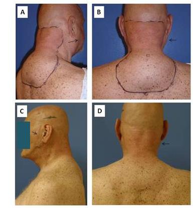 Novel Liposuction Techniques for the Treatment of HIV-Associated Dorsocervical Fat Pad and Parotid Hypertrophy 51 placement of the patient in the prone position and visibly noting the dorsal surface