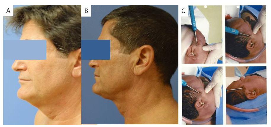Novel Liposuction Techniques for the Treatment of HIV-Associated Dorsocervical Fat Pad and Parotid Hypertrophy 57 check, it is important to maintain a superficial position in order not to compromise