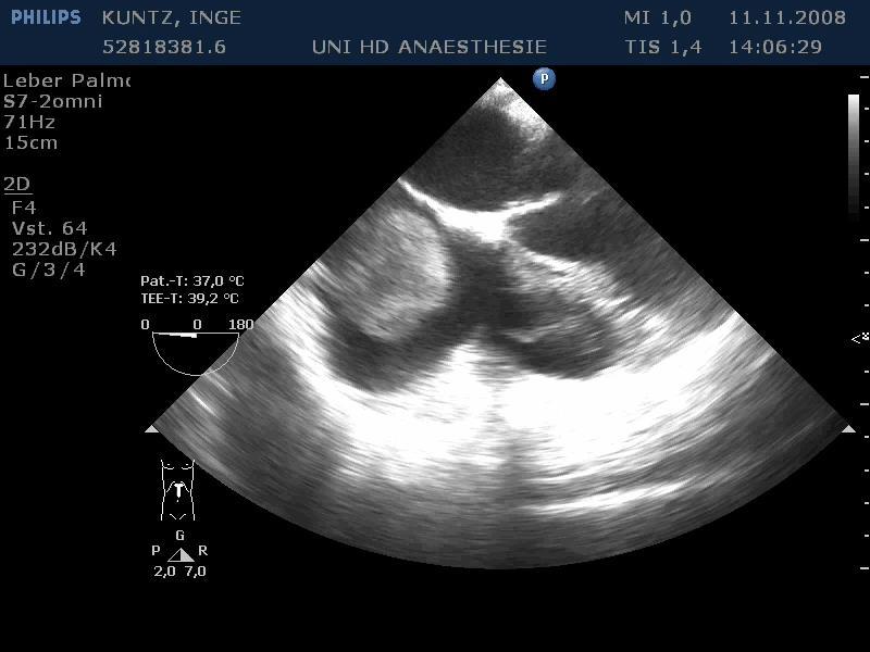Intraoperative transesophageal ultrasound Exact definition of IVC thrombus level