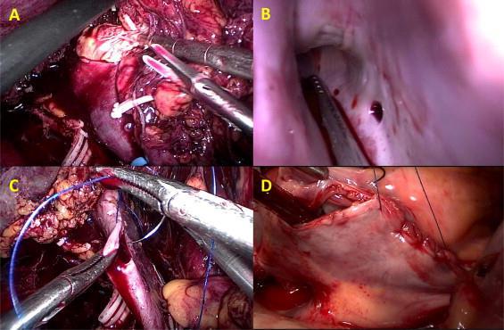 open atriotomy for thrombectomy CPB & hypothermia (33-35 C) Clamping of infrarenal IVC, left renal vein &