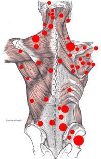 Hyperirritable spots of skeletal muscles or fascia associated with palpable nodules in taunt bands of