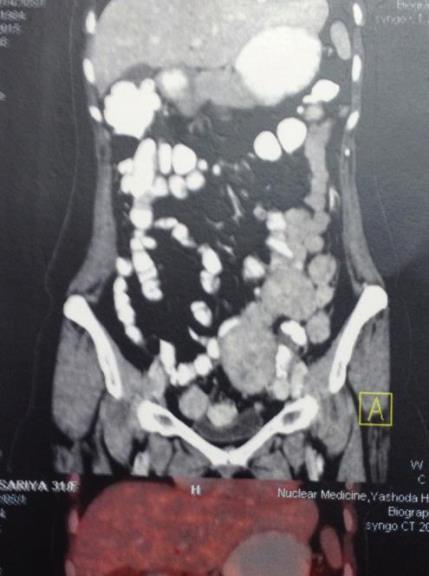 and lower abdomen bilaterally-suggestive of metastatic nodes and ascites.
