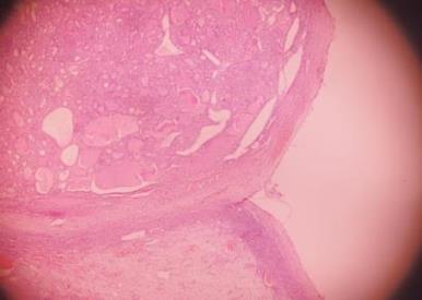 Figure 7: Intranuclear grooves are seen as proliferative struma ovarii with nuclear atypia.