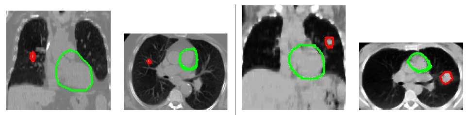 Heart segmentation for oncology