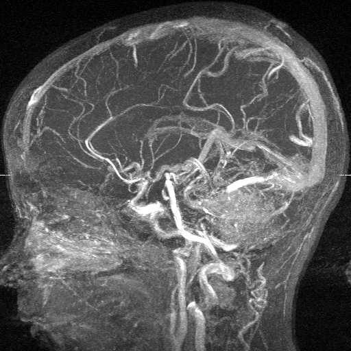 Segmentation of brain vessels from MRA (B.