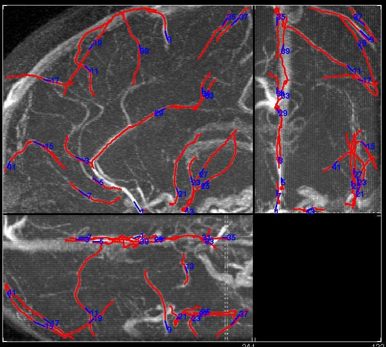 Segmentation of brain vessels from MRA (B.