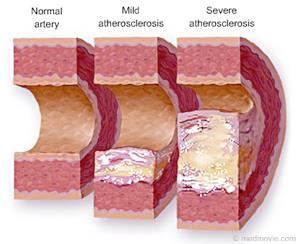 Cholesterol is a type of fat that our bodies need to work properly We all have cholesterol in our blood. There are two kinds of cholesterol. Bad cholesterol is dangerous for the body.