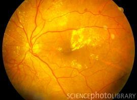 A urine sample can tell us if your kidneys are working well. High blood glucose levels and high blood pressure may damage the back of your eyes called the retina.