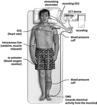 Brain Stimulation Electroconvulsive Therapy (ECT) ECT is used for severely depressed patients who do not respond