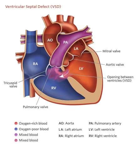 What are Septal Defects? The two main types of septal defects are called ventricular septal defects (VSD) and atrial septal defects (ASD).