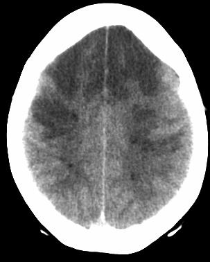 suspected MR (at admission): characteristic changes of cerebral arteries