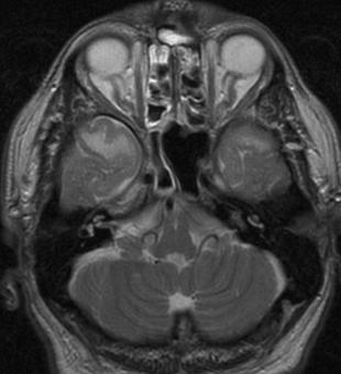 Case 5 HF CADASIL Cerebral autosomal dominant arteriopathy with