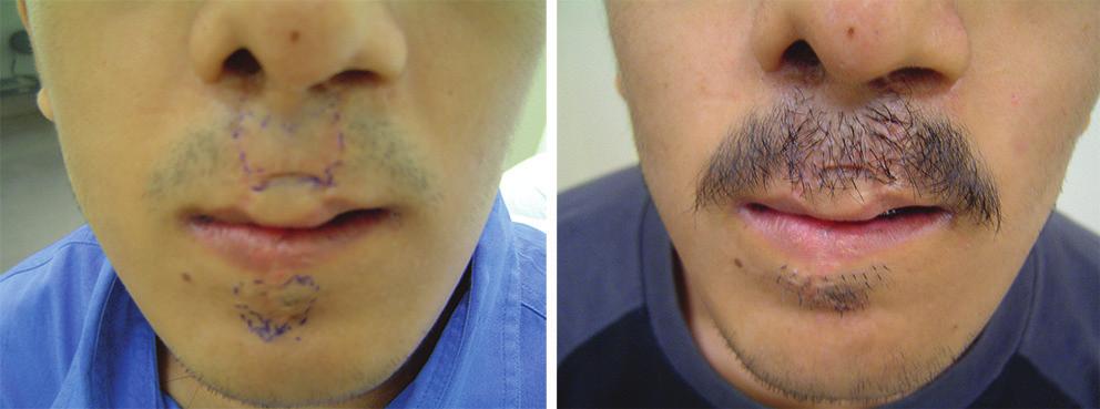 Out of these, 3 moustache restorations were done with FUT scalp strip harvesting technique and 15 cases were done with FUE, individual FUE technique.