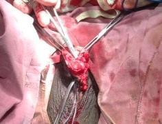leads to loss of urethral support and hence diverticula. We strongly feel visual urethrotomy though easier to perform, has its share of complications including that of urethral diverticulum.