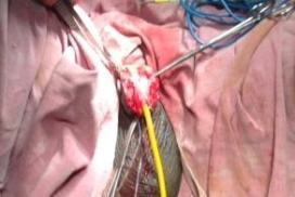 All patients had good outcomes except one patient who developed stricture following primary excision and anastamosis, hence required a further procedure.