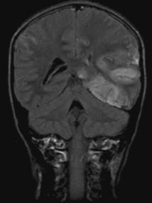 MRI Brain HSV-1 Meningoencephalitis Diagnosis CSF lymphocytic pleocytosis