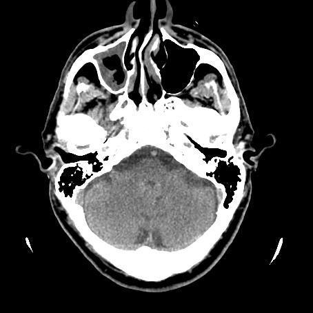 Normal CT Brain Which of the following most reliably distinguishes central from peripheral