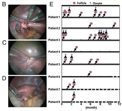 Ovarian fragmentation/akt stimulation followed by autografting promoted follicle growth in POI