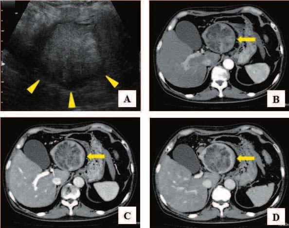 268 D. Ishikawa, et al. Atypical hepatocellular carcinoma CASE REPORT Computed tomography (CT) of a 68-year-old man revealed a hepatic mass of 40 mm in diameter.