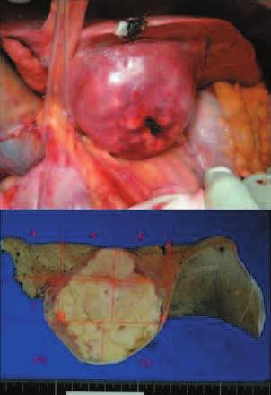 The Journal of Medical Investigation Vol. 60 August 2013 269 Left lateral segmentectomy was performed with clear surgical margins.