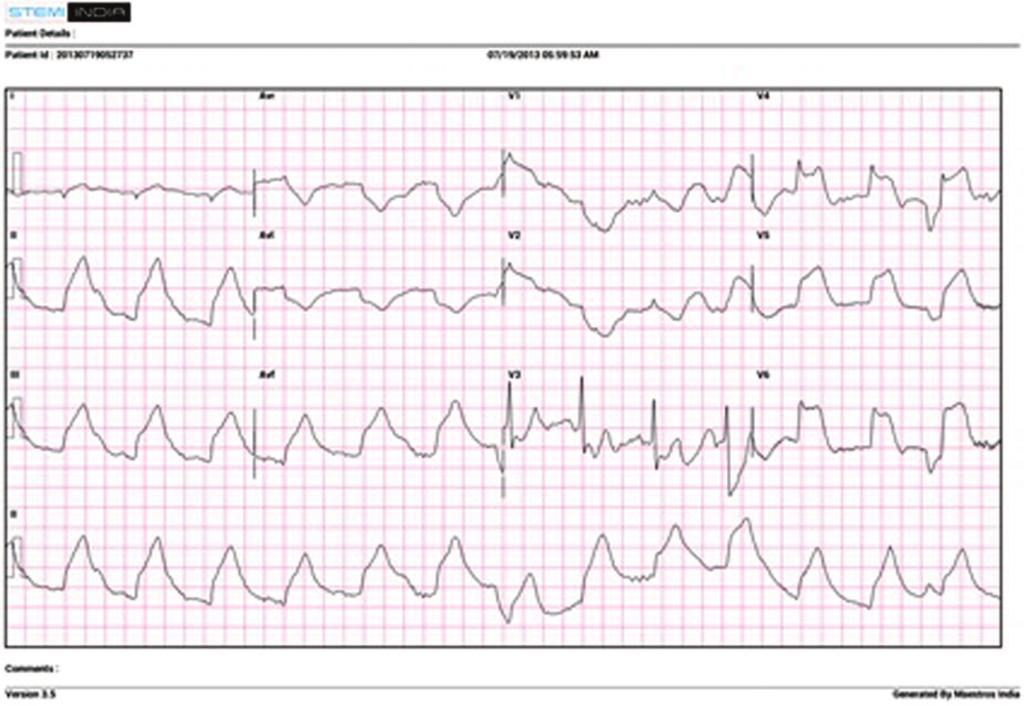Electrocardiogram showing hyperacute inferolateral