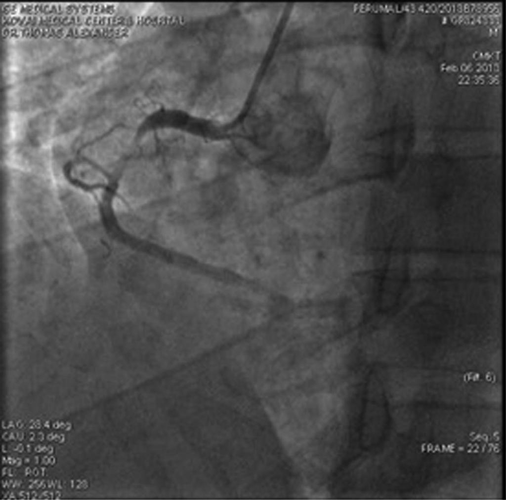 CardioPulse 2453 Figure 9 Pre-percutaneous coronary intervention images of the culprit vessel, right coronary artery.