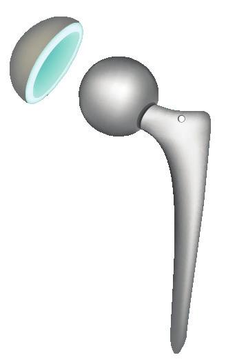 What is a total hip replacement?