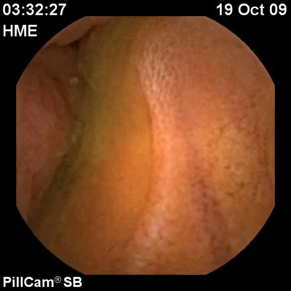 Capsule Endoscopy Gastric passage time 6 minutes The abnormality appeared at 1 hr 13 minutes