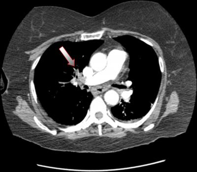 Figure 3 Figure2. Helical CT scan of the chest reveals intraluminal filling defect in the right main pulmonary artery (arrow) Figure 5 Figure(4).
