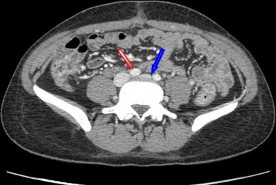 Helical CT scan of the pelvis demonstrating compression of the left common iliac vein (Blue arrow) as it passes under the right common iliac artery (Red arrow).