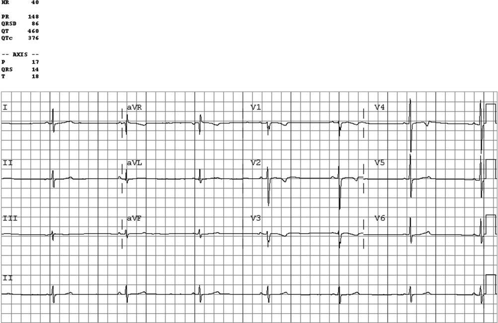 NORMAL ECG FINDINGS IN ATHLETES Sinus bradycardia The normal heartbeat is initiated by the sinus node which is located high in the right atrium near the junction of the superior vena cava and the