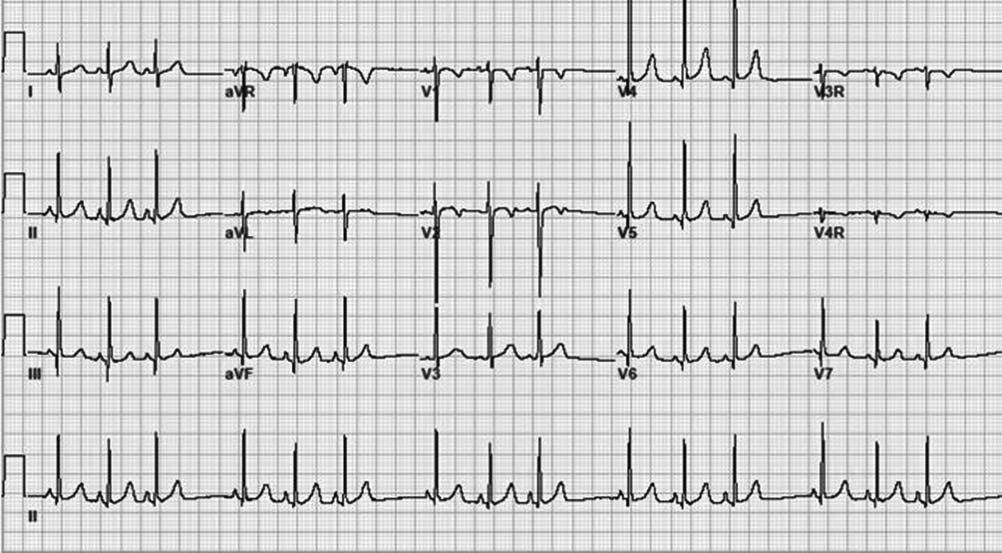 Figure 3 ECG demonstrates sinus arrhythmia. Note the irregular heart rate that varies with respiration. The P waves are upright in leads I and avf (frontal plane) suggesting a sinus origin.