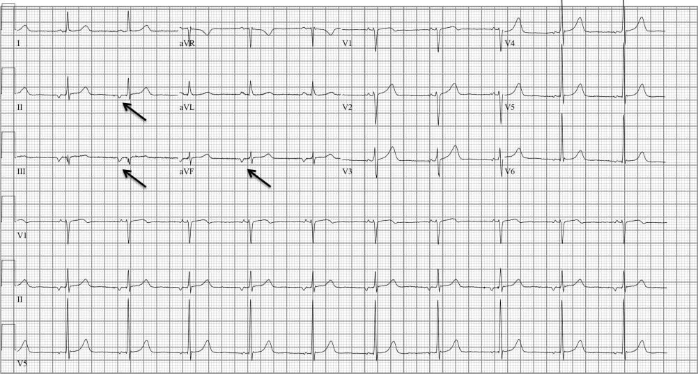 Figure 5 ECG shows an ectopic atrial rhythm. The atrial rate is 63 beats/min and the P wave morphology is negative in leads II, III and avf (arrows), also known as a low atrial rhythm.