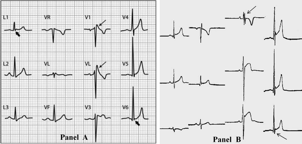 Figure 9 ECG from a patient with arrhythmogenic right ventricular cardiomyopathy showing delayed S wave upstroke in V1 (arrow), low voltages in limb leads < 5 mm (circles) and inverted T waves in