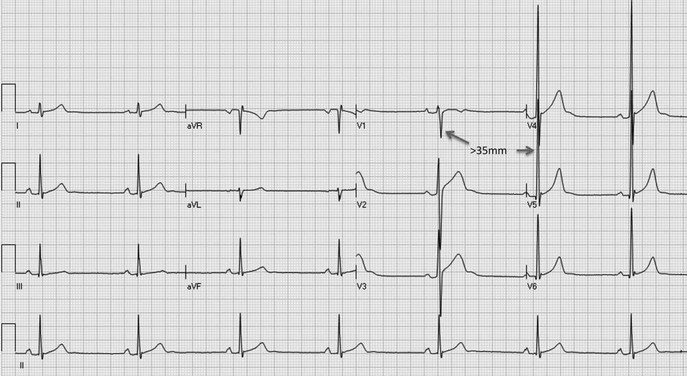 Figure 13 ECG from a 19-year-old asymptomatic soccer player demonstrating voltage criteria for left ventricular hypertrophy (S-V1+R-V5>35 mm).