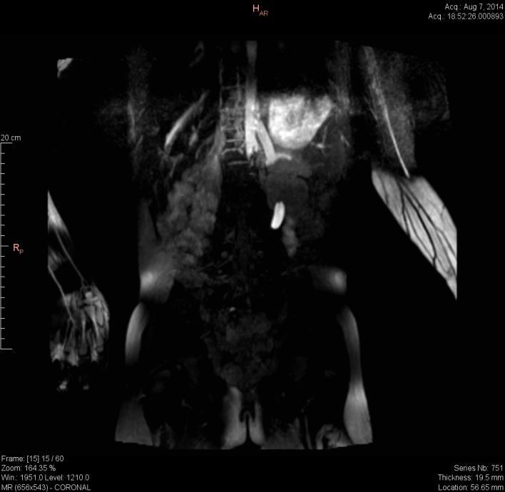 Page 13 9 year old girl, 24kg Previous right nephrectomy (dysplasia)