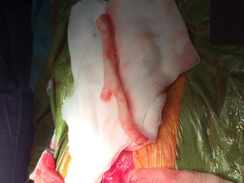 Page 15 Surgery Recipient before donor Dense adhesions Split