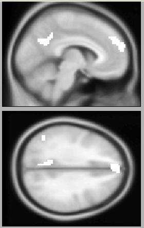 Neural response to tailored messages and quitting Page 11 L parietal lobule L supramarginal gyrus R Superior Temporal Gyrus 22, 21 57, 30, 0 4.24 88 R middle temporal gyrus L Cerebellum 15, 78, 27 4.