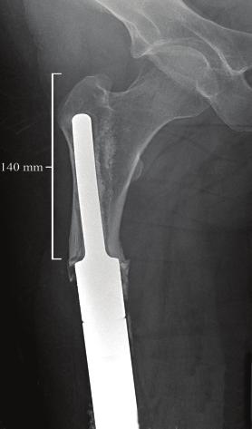 2 Advances in Orthopedics Figure 1: Short stemmed cemented endoprosthesis with aseptic loosening. Figure 4: Distal femur APC.