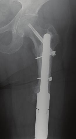 composite (APC) reconstruction restores bone stock which allows the use of a longer stem, increases intraoperative flexibility, and