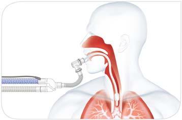 Respiratory Humidification Normal airway humidification is bypassed or