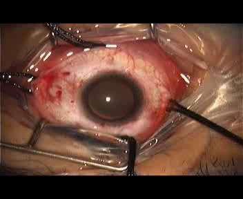 quadrants 2-diffuse retinal pathology
