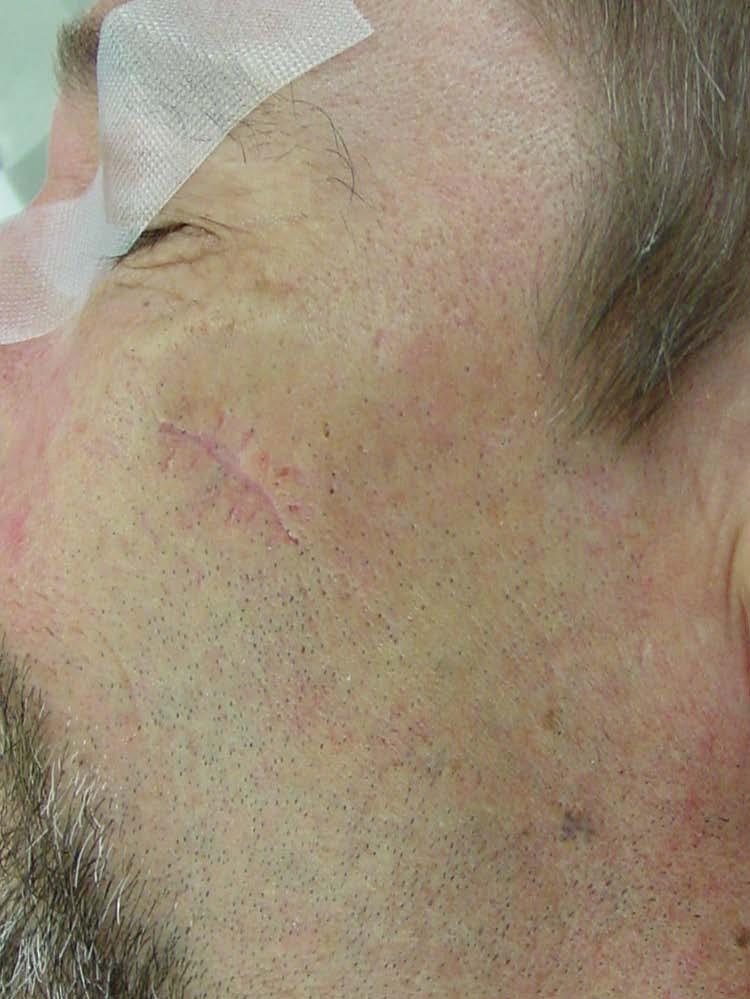 This patient had a resected basal cell carcinoma of the cheek with positive margins.
