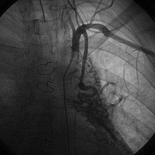 Bronchial artery embolization - technical comments Some important considerations Cut the tree from the root? Not a good option Embolize as distal as possible.