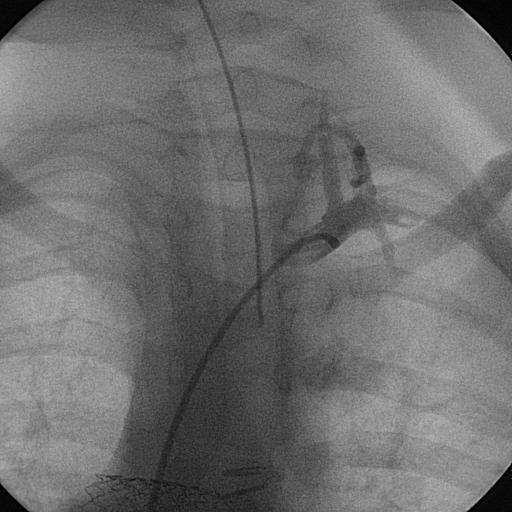 Bronchial artery embolization - technical comments Selective target vessel catheterization Inject slowly