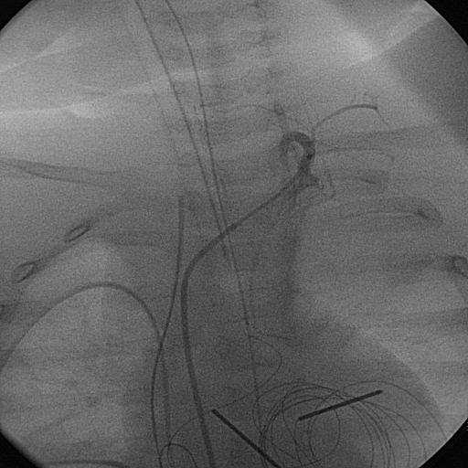 Bronchial artery embolization Some examples