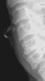 The lung apices are often projected over the lower neck region Prevertebral soft tissue swelling in 12 year old girl who complained of pain with difficulty swallowing. She also had a fever.