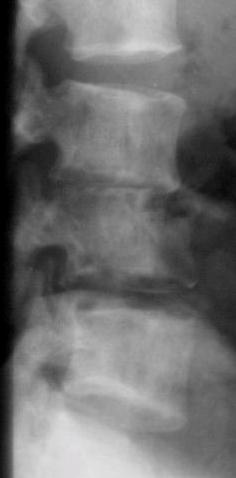 5. Infection this was also covered in the chapters on skeletal imaging Infection involving the spine usually involves two adjacent vertebra with involvement of the intervertebral isc.
