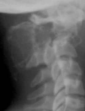 Causes of vertebral body destruction: - infection - tumour - metastases - myeloma A destructive lesion in a vertebral body will eventually lead to