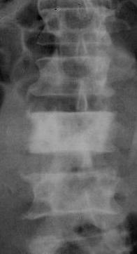 This was an aneurysmal bone which responded well to radiotherapy A lytic lesion may completely destroy a vertebral body as in this case.